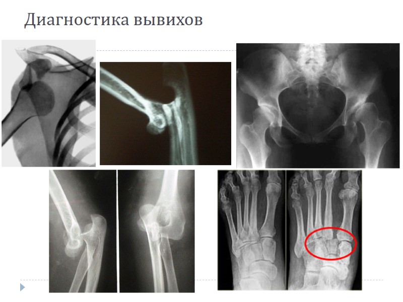 Диагностика вывихов